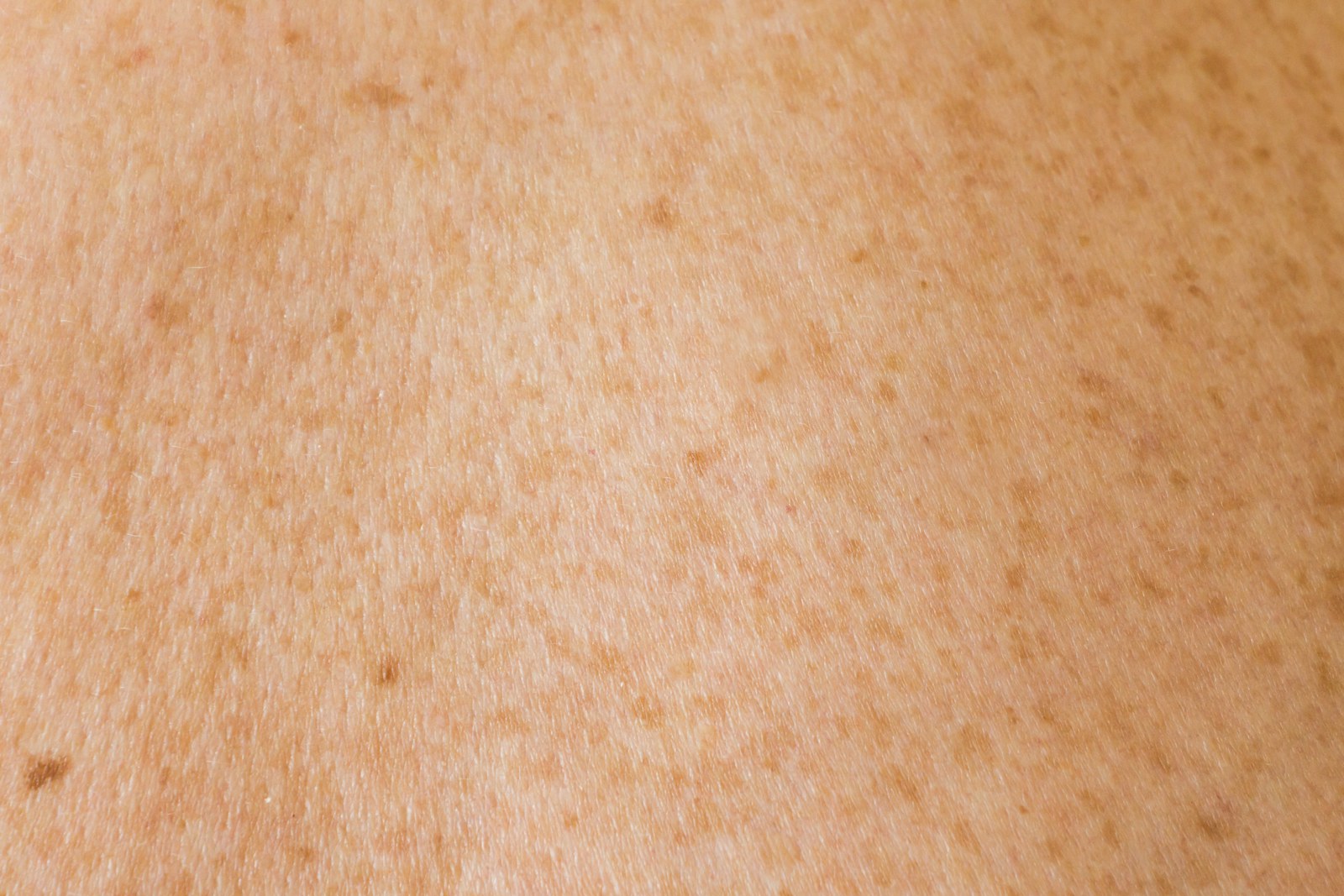 Mole Removal in Manchester